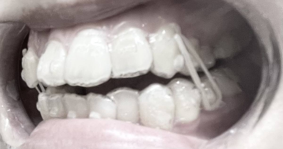 フックにゴムかけをして横から見た写真